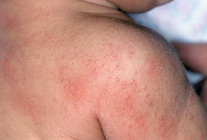 Алергічна висипка на спині дитини часте явище