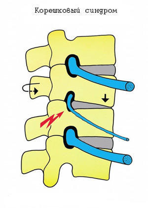 Симптомом корінцевого синдрому шийного відділу є біль по ходу нервових волокон