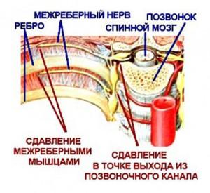 Причиною міжреберної невралгії є компресія або роздратування міжреберних нервів