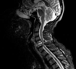 Цервікальна мієлопатія має дуже складні симптоми небезпечні наслідки