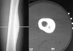 osteoid-osteoma-2