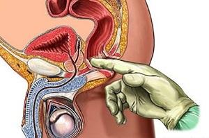 Пальцеве дослідження прямої кишки при діагностиці кокцигодинии