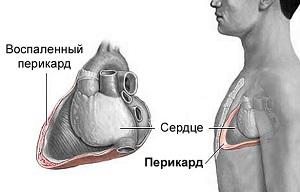 запалення серозної оболонки міокарда