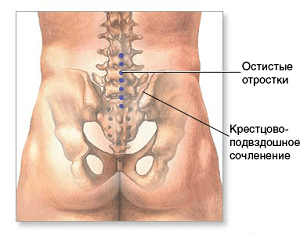 Біль у крижах називають сакродинией