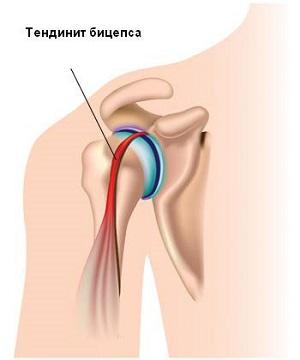tendinit-bicepsa1
