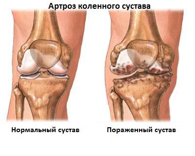 Гонартроз колінного суглоба 2 ступеня фото