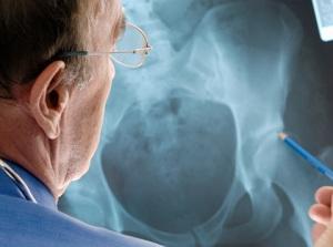 Діагноз "остеопороз кульшового суглоба" може поставити тільки фахівець
