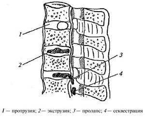 Екструзія міжхребцевого диска