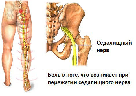 ішіас лікування і симптоми