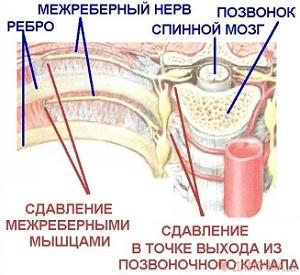 Міжреберна невралгія є супутнім симптомом інших серйозних патологій