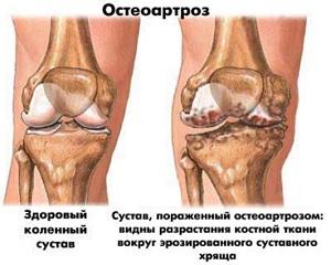 остеоартроз колінного суглоба